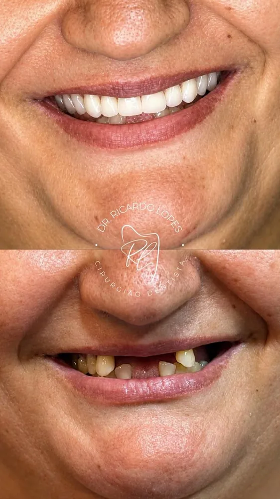 Resultado real de reabilitação do sorriso realizada pelo Dr. Ricardo Lopes — antes e depois